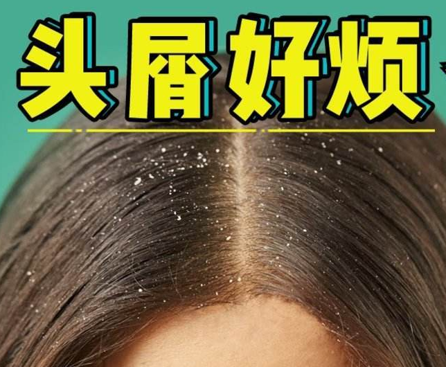 南寧正規(guī)美發(fā)培訓(xùn)學(xué)校分享：冬天如何減少頭屑過(guò)多？