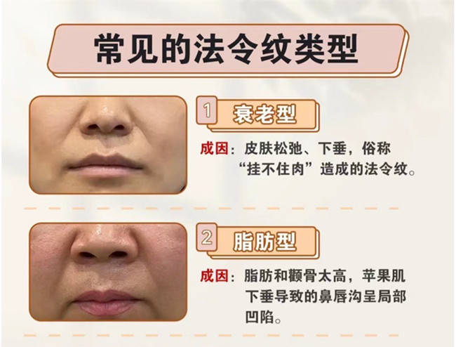 你的法令紋路是怎么產生的 | 美容護膚小知識